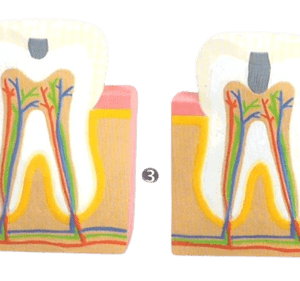 four giant molar with dental caries